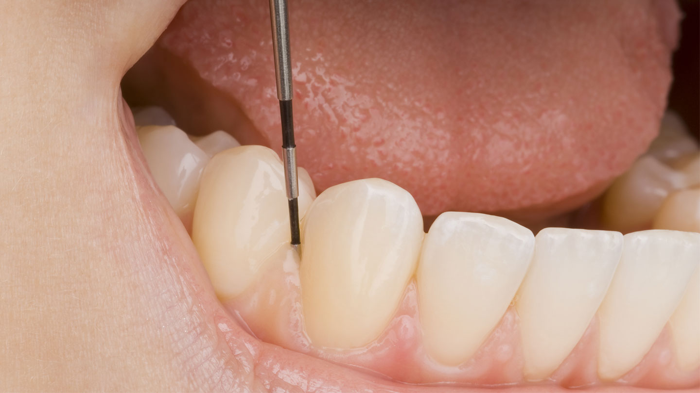 „Zahnbelag und Parodontitis“, Zahnärztlicher Fach-Verlag